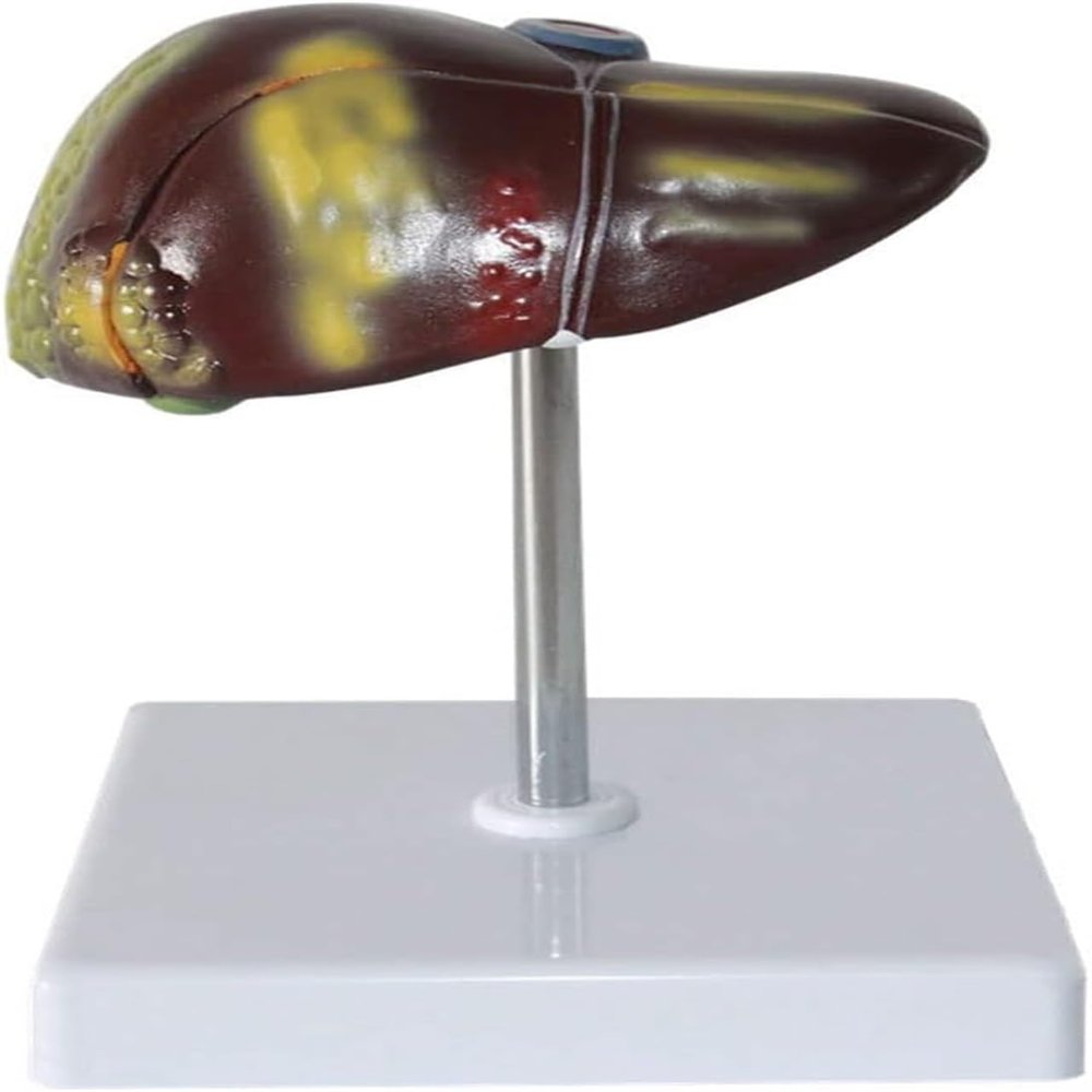 Gallbladder Anatomy Model, Human Liver Pathology Educational Model, Life Size Liver Disease Anatomical Model, Fatty Cirrhosis Carcinoma Hepatobiliary Disease Model, 2 Detachable Parts for Teaching.